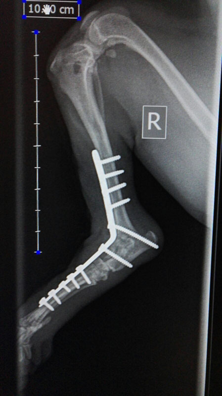 Partial Tarsal, Pantarsal Arthrodesis